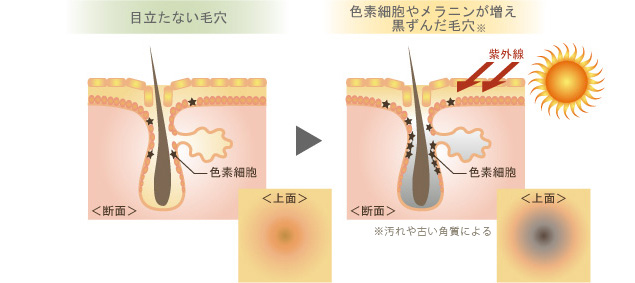 目立たない毛穴 色素細胞やメラニンが増え黒ずんだ毛穴※汚れや古い角質による