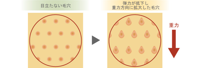 目立たない毛穴 弾力が低下し重力方向に拡大した毛穴